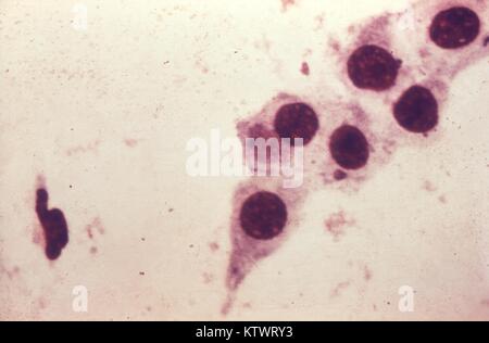 Photomicrograph von Chlamydia trachomatis aus einem Urethralen kratzen. Unbehandelt, chlamydia, kann es zu schweren, teuren reproduktive und andere Gesundheit Probleme einschließlich der kurz- und langfristigen Folgen, d. h. Becken- entzündliche Krankheit (PID), Unfruchtbarkeit und potenziell tödlichen Eileiterschwangerschaft, 1973 verursachen. Bild mit freundlicher Genehmigung von CDC/Dr. Wiesner, Dr. Kaufman. Stockfoto