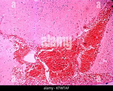 Eine Demonstration der photomicrograph histopathologic Veränderungen im Hirngewebe durch Salmonella typhi Bakterien. Salmonellen Septikämie hat mit anschließender Infektion praktisch jedes Organsystem verbunden gewesen, und das Nervensystem ist keine Ausnahme. Hier sehen wir eine akute entzündliche Enzephalitis durch S. typhi Bakterien. Mit freundlicher CDC/Streitkräfte Institut für Pathologie, Charles N. Bauer, 1964. Stockfoto