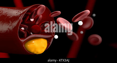 Verstopfte Blutgefäß, Arterie mit Cholesterin Anhaftungen realistische 3D-Darstellung. Stockfoto