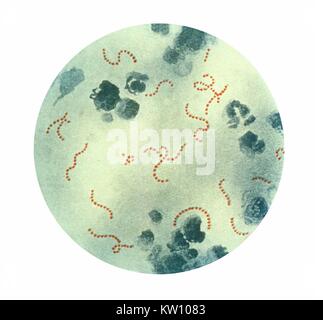 In dieser Abbildung wird eine photomicrographic Ansicht von Streptococcus pyogenes Bakterien bei einer Vergrößerung von 900 X. Eine eiter Muster, mit gesehen Pappenheim der Fleck. Jahrhunderts, Infektionen durch S. pyogenes behauptete viele Leben, vor allem, da der Organismus die wichtigste Ursache war der Kindbettfieber und Scharlach. Streptokokken. Mit freundlicher Genehmigung der CDC, 1979. Stockfoto