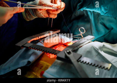 Invasive chirurgische Ansatz mit einem kleinen Schnitt für Herz Ventil Chirurgie für das Entfernen der transcatheter aortic Stockfoto