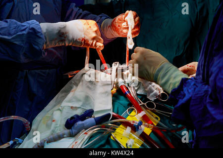 Chirurgen führen Sie die Operation durch. Nahaufnahme von Doctor's Hand in Handschuhe während der Operation. Gesundheitswesen und Medizinische Konzept. Aseptische chirurgische Instrumente Stockfoto