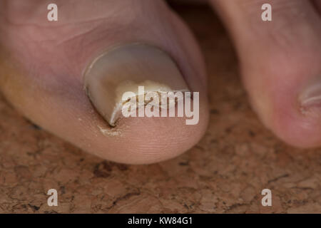 Trauma Verletzung durch dicht schließende Sport Schuhe die Nagelplatte abheben Bett und Öffnung Bereich Pilzinfektion Onychomykose zu zehennagel Stockfoto