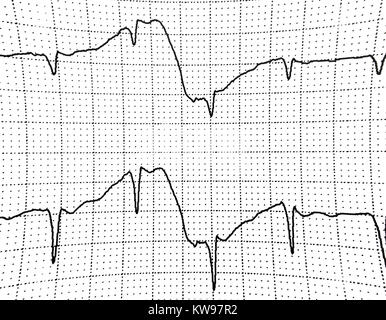Ekg-Test zeigt, dass die elektrische Aktivität des Herzens Stockfoto