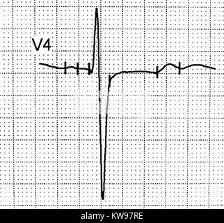 Ekg-Test zeigt, dass die elektrische Aktivität des Herzens Stockfoto