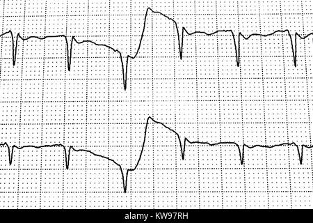 Ekg-Test zeigt, dass die elektrische Aktivität des Herzens Stockfoto