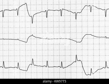 Ekg-Test zeigt, dass die elektrische Aktivität des Herzens Stockfoto