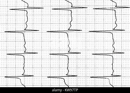 Ekg-Test zeigt, dass die elektrische Aktivität des Herzens Stockfoto