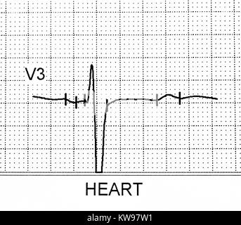 Ekg-Test zeigt, dass die elektrische Aktivität des Herzens Stockfoto