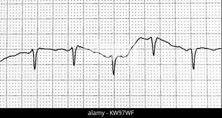 Ekg-Test zeigt, dass die elektrische Aktivität des Herzens Stockfoto