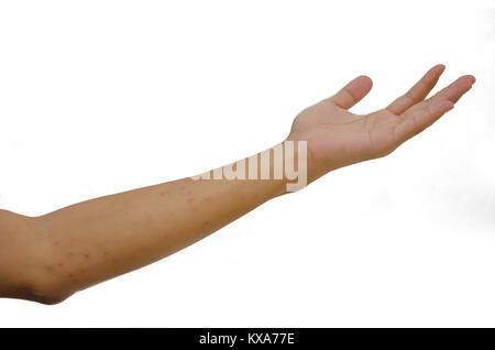 Hautausschlag im Arm auf den weißen Hintergrund. Stockfoto