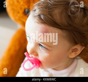 Kleinkind mit großen blauen Fleck auf der Stirn nach stoßen. Kinder oft versehentlich den Kopf stoßen. Stockfoto