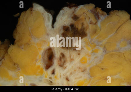 Medizinisches Bild mit Endometriose, die die Bauchwand beeinflusst, zeigt abnormales Wachstum des Endometriumgewebes außerhalb der Gebärmutter und seine Auswirkungen auf die umgebenden Strukturen. Stockfoto