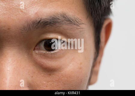 Asiatische männlich Mann Gesicht fettige Haut mit Big Eye Beutel am linken Auge Stockfoto