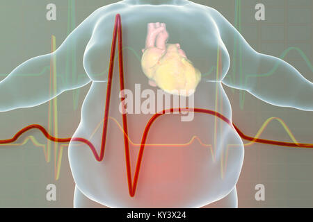 Herzinfarkt bei übergewichtigen Menschen. Prinzipdarstellung zeigt eine fetthaltige Herz in ein übergewichtiger Mann und ein Elektrokardiogramm mit Anzeichen von Myokardinfarkt (Herzinfarkt). Stockfoto