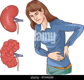 Vector Illustration einer chronischen Nierenerkrankung Stock Vektor