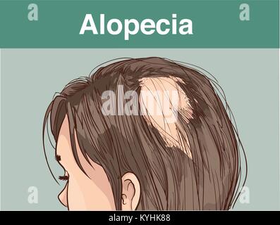 Vector Illustration von aFemale Alopezie Stock Vektor