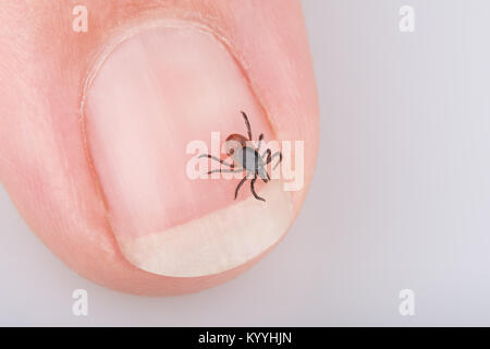 Close-up Tick auf die menschliche Nagel. Ixodes ricinus. Gefährliche Parasiten und Träger der Infektion wie Enzephalitis und Borreliose. Stockfoto