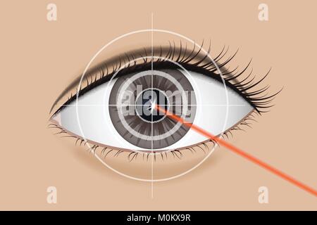 Zur Laser-Sehkorrektur Stock Vektor