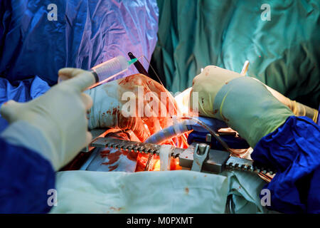 Weiche natürliche Hintergrund. Chirurgen während einer Operation am offenen Herzen Stockfoto