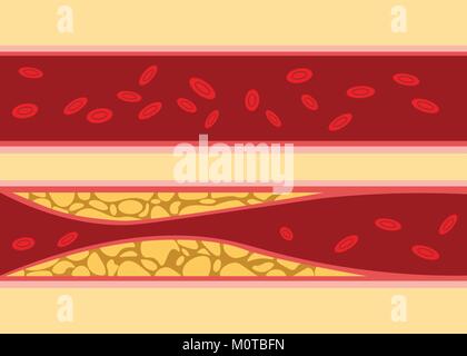 Vergleich zwischen normalen und ungesundes Cholesterin menschliches Blut Vene Zelle Stream fließen mit Fett auf der Seite mit dem Flat Style Abbildung Stock Vektor