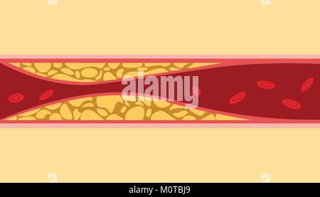 Un-gesunden Cholesterin menschliches Blut Vene Zelle Stream fließen mit Fett auf der Seite mit dem Flat Style Abbildung Stock Vektor
