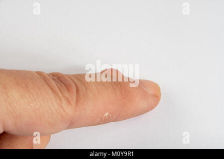 Ganglion Zysten wachsen auf einem Finger Stockfoto