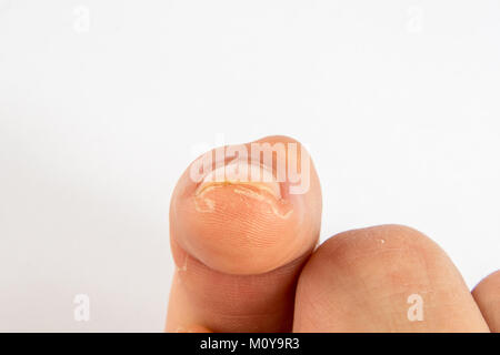 Ganglion Zysten wachsen auf einem Finger Stockfoto