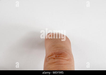 Ganglion Zysten wachsen auf einem Finger Stockfoto