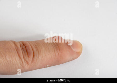 Ganglion Zysten wachsen auf einem Finger Stockfoto