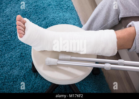 Ansicht des Mannes gebrochenes Bein in Gips Stockfoto