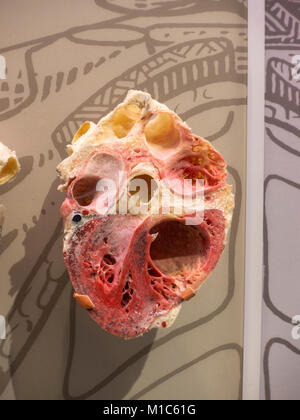 Ein Plastinierter Herz auf Anzeige im Nationalen Museum für Gesundheit und Medizin, Silver Spring, MD, USA. Stockfoto