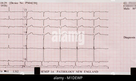 Ekg Ausdruck für männliche Herzpatienten. Stockfoto