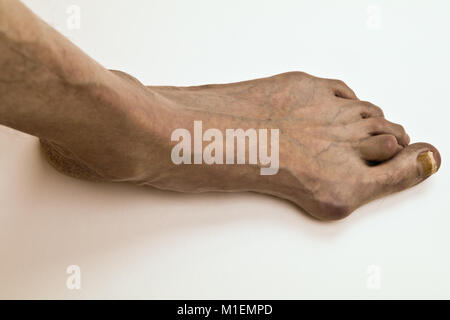 Mißbildung der menschliche Fuß - Hallux valgus Stockfoto