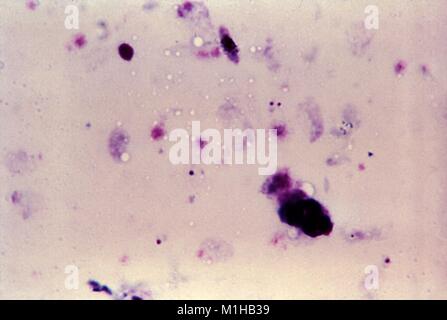 Plasmodium falciparum Ringe in Dickschicht Blutausstrich, 1966 gefunden. Mit freundlicher Seuchenkontrollzentren (CDC)/Dr. Mae Melvin. () Stockfoto