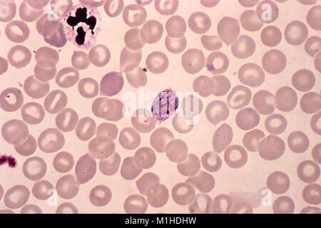 Photomicrograph einer Giemsa-befleckte schizont von Plasmodium vivax, ein Parasit, der die Malaria verursacht, mit fünf chromatin Massen, 1977. Bild mit freundlicher Genehmigung von CDC/Dr. Mae Melvin. () Stockfoto