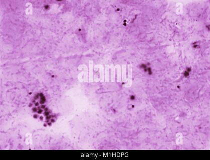 Photomicrograph von Malaria, eine Mücke übertragene Krankheit, die durch einen Parasiten verursacht, der Brain durch Plasmodium falciparum, 1966. Bild mit freundlicher Genehmigung von CDC/Dr. Mae Melvin. () Stockfoto