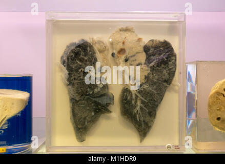 Ein Raucher Lunge mit Karzinom (Krebs) im National Museum von Gesundheit und Medizin, Silver Spring, MD, USA. Stockfoto