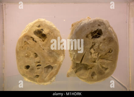 Menschlichen Nieren leiden von Plattenepithelkarzinomen im Nationalen Museum für Gesundheit und Medizin, Silver Spring, MD, USA. Stockfoto