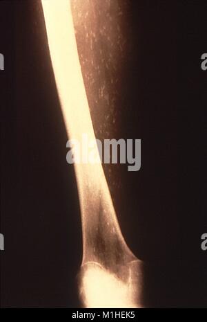 Rindfleisch Bandwurm (Taenia saginata) verursacht Cysticercose des Muskels, die durch die x-ray, 1986 aufgedeckt. Mit freundlicher Seuchenkontrollzentren (CDC). () Stockfoto