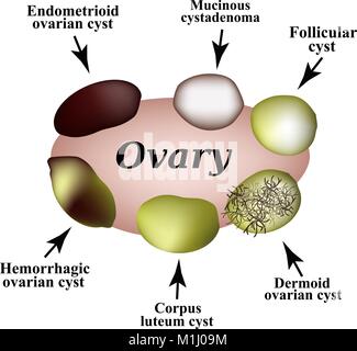 Arten von ovarialzysten. Eingestellt. Infografiken. Vector Illustration auf isolierte Hintergrund Stock Vektor