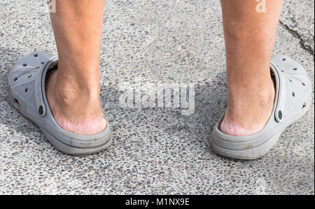 Crocs Sandalen. Person tragen Crocs ohne Socken. Rissige Haut an Ferse Stockfoto