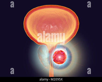 Die Behandlung des Prostatakrebses, konzeptionelle Darstellung. Stockfoto