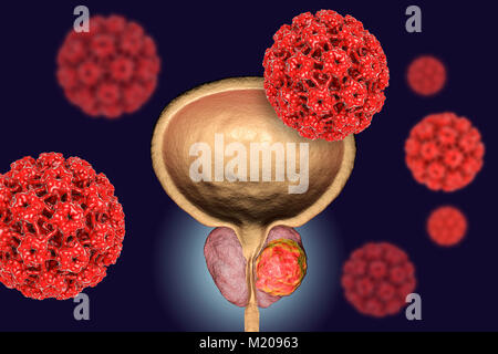 Virale Ätiologie von Prostatakrebs. Konzeptionelle Abbildung: Humane Papillomviren (HPV) infizieren und Prostata Krebs Entwicklung. Stockfoto