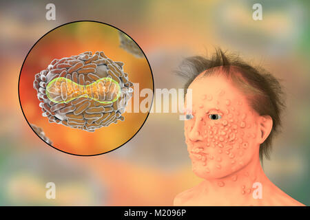 Pocken Virus und Krankheit, Illustration. Eine virale Membran (transparent) von seiner Wirtszelle abgeleitet umfasst die Viruspartikel. In diesem liegt der Kern (rot), welche das Partikelfilter DNA (Desoxyribonukleinsäure) genetischen Material enthält. Der Kern hat eine biconcave Form. Die Oberfläche des Virus ist mit einer Fläche von Tubuli, die das Virus in die Wirtszelle Hilfe. Pocken ist eine Krankheit, die dazu führt, dass Fieber und oft den Tod. Er wurde nach einem weltweiten Bemühungen in den 70er Jahren ausgerottet, Belastungen gibt es in Forschungslabors. Stockfoto