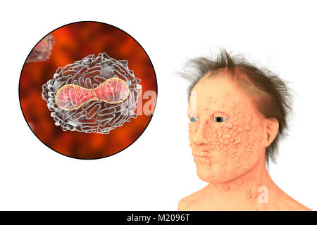 Pocken Virus und Krankheit, Illustration. Eine virale Membran (transparent) von seiner Wirtszelle abgeleitet umfasst die Viruspartikel. In diesem liegt der Kern (rot), welche das Partikelfilter DNA (Desoxyribonukleinsäure) genetischen Material enthält. Der Kern hat eine biconcave Form. Die Oberfläche des Virus ist mit einer Fläche von Tubuli, die das Virus in die Wirtszelle Hilfe. Pocken ist eine Krankheit, die dazu führt, dass Fieber und oft den Tod. Er wurde nach einem weltweiten Bemühungen in den 70er Jahren ausgerottet, Belastungen gibt es in Forschungslabors. Stockfoto