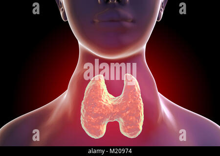 Thyrotoxic Struma (Kropf), Illustration. Kropf (geschwollenen Hals) gesehen auf eine Frau, die Patienten leiden unter einer Überfunktion der Schilddrüse. Ein kropf wird durch die Vergrößerung der Schilddrüse verursacht und können in der Größe von einem kleinen Klumpen zu einem enormen Schwellung variieren. Überaktivität der Schilddrüse, auch bekannt als thyreotoxikose, Ergebnisse in der Überproduktion der Schilddrüsenhormone im Körper. Dies kann in Symptome reichen von Gewicht Verlust führen und verstärkter Appetit zu Herzen zittern und Muskelschwund. Zu den Behandlungen zählen Drogen schilddrüseproduktion oder chirurgische Entfernung der Schilddrüse zu begrenzen. Stockfoto