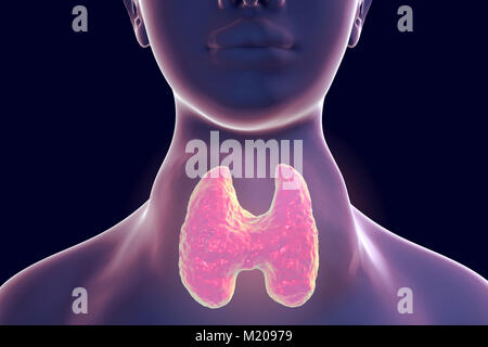 Thyrotoxic Struma (Kropf), Illustration. Kropf (geschwollenen Hals) gesehen auf eine Frau, die Patienten leiden unter einer Überfunktion der Schilddrüse. Ein kropf wird durch die Vergrößerung der Schilddrüse verursacht und können in der Größe von einem kleinen Klumpen zu einem enormen Schwellung variieren. Überaktivität der Schilddrüse, auch bekannt als thyreotoxikose, Ergebnisse in der Überproduktion der Schilddrüsenhormone im Körper. Dies kann in Symptome reichen von Gewicht Verlust führen und verstärkter Appetit zu Herzen zittern und Muskelschwund. Zu den Behandlungen zählen Drogen schilddrüseproduktion oder chirurgische Entfernung der Schilddrüse zu begrenzen. Stockfoto