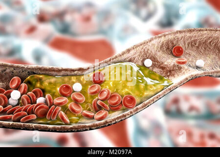 Atheromatous Plakette im Blutgefäß, Computer Bild. Ein Atherom Cholesterin verursacht eine Verengung einer Arterie (Arteriosklerose). Stockfoto