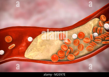 Atheromatous Plakette im Blutgefäß, Computer Bild. Ein Atherom Cholesterin verursacht eine Verengung einer Arterie (Arteriosklerose). Stockfoto